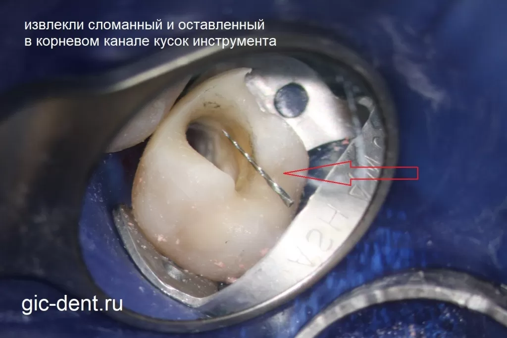 Сломанный инструмент извлекли из канала корня зуба