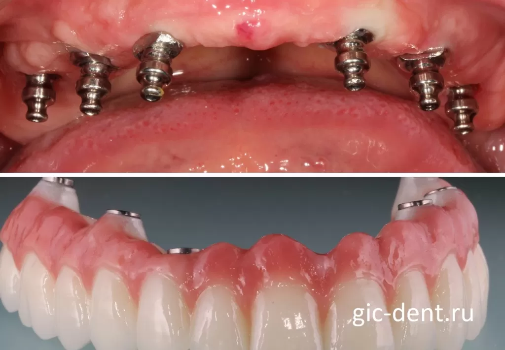 Методика все на 6 и более - оптимальный вариант для восстановления зубов