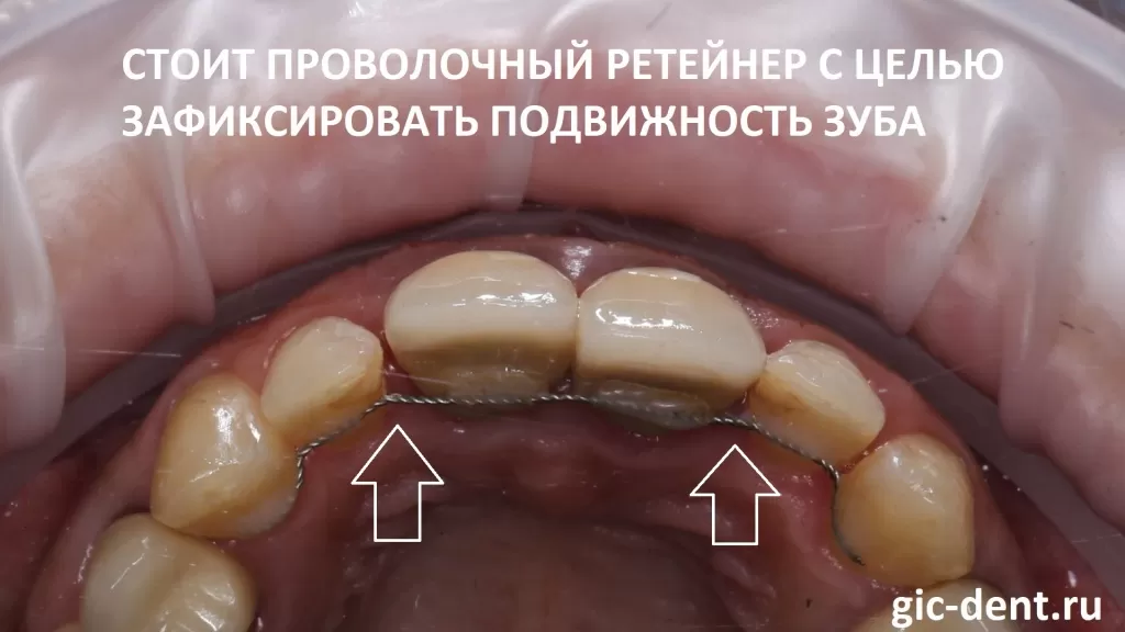 Передний зуб начал шататься и поэтому в другой клинике был зафиксирован ретейнер