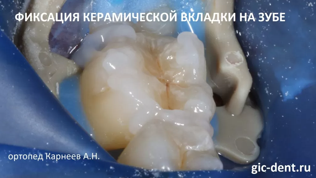 Установку керамической вкладки на 6 зуб проводит ортопед НИЦ Карнеев Андрей Николаевич