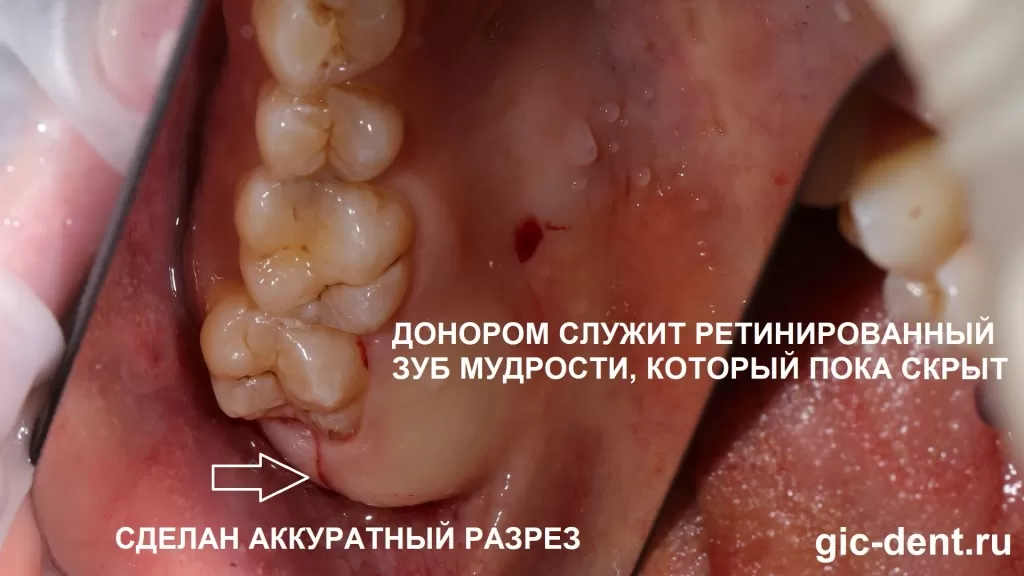 Нужный нам зуб – ретинированная верхняя восьмерка, пока скрыт, находится под десно