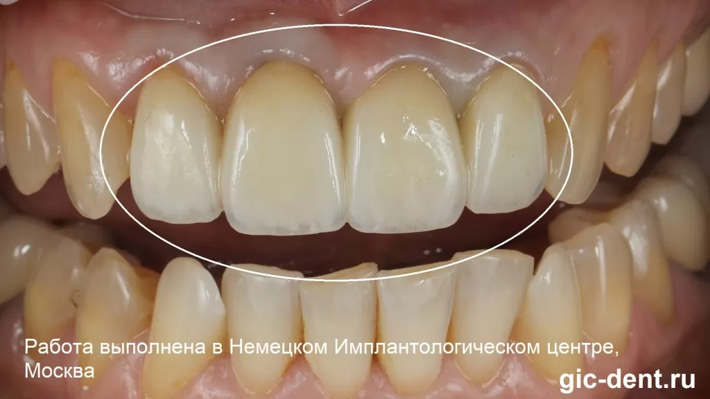 Как восстановить зубы, если они разрушены ниже уровня десны. Немецкий имплантологический центр, Москва