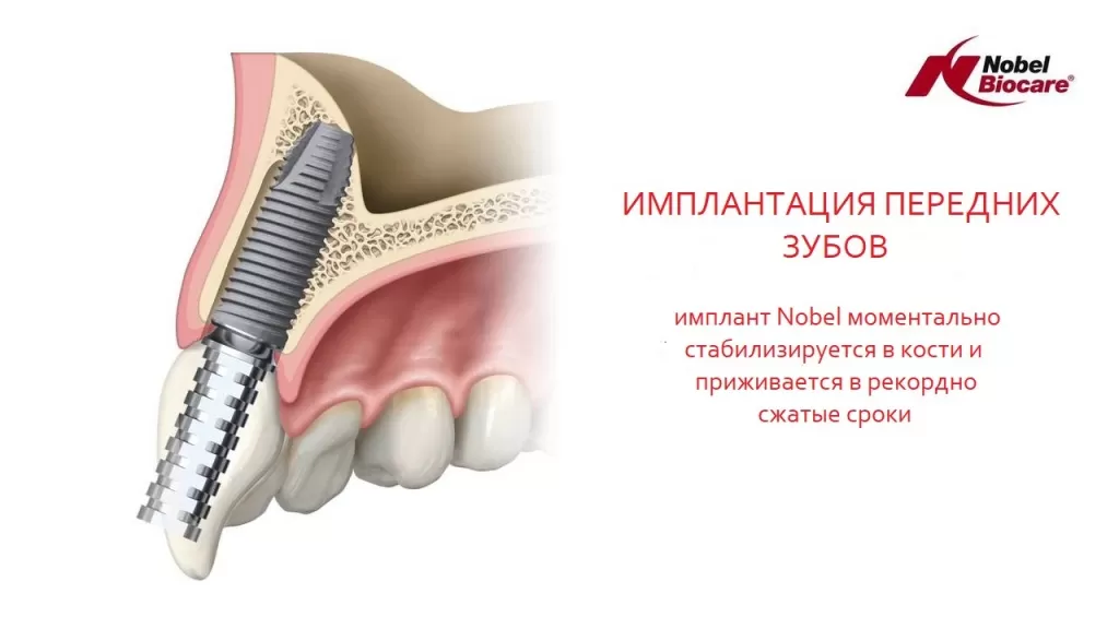Имплант NobelParallel CC — решение для передних зубов, позволяющее сформировать достаточный объем мягких тканей вокруг искусственного зуба в стоматологической клинике DrShorbatov