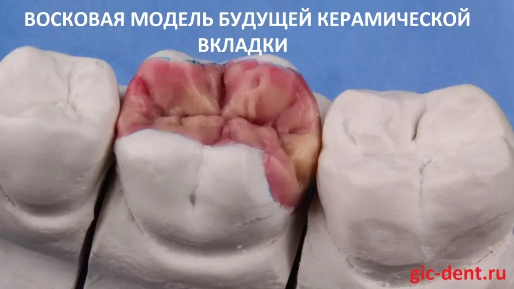 Техник моделирует всю анатомию, полностью воссоздав будущий вид зуба с вкладкой. Автор работы - ортопед Карнеев Андрей Николаевич, Немецкий имплантологический центр