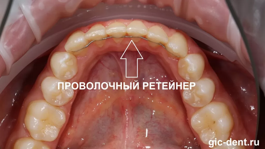 У Виктории на верхнем и нижнем зубных рядах было установлено два проволочных ретейнера. 
