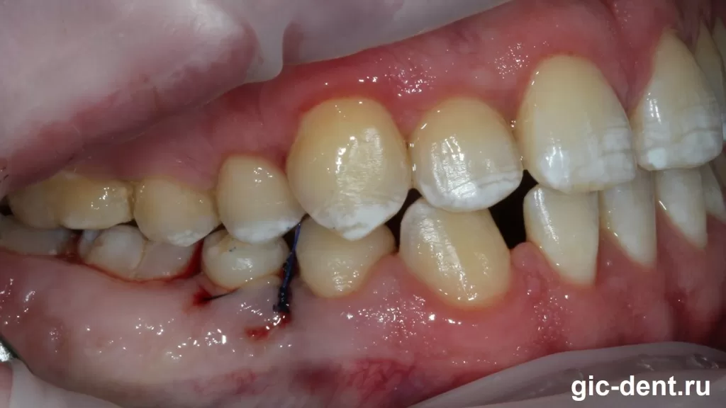 Имплантация зуба при аутизме пациента путем пересадки собственного сверхкомплектного зуба успешно завершена