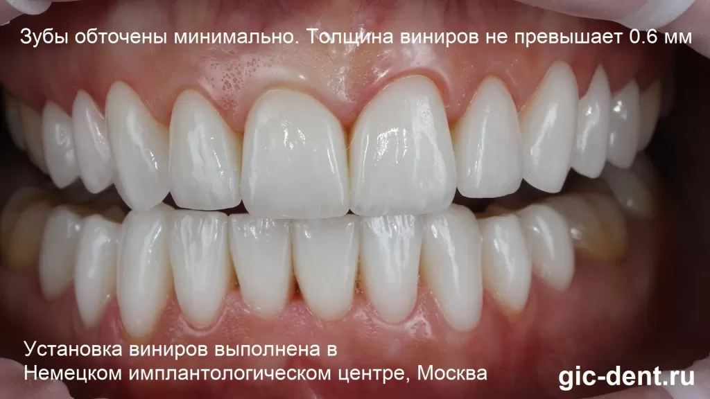Обточка зубов при установке таких керамических виниров минимальна - Немецкий имплантологический центр, Москва