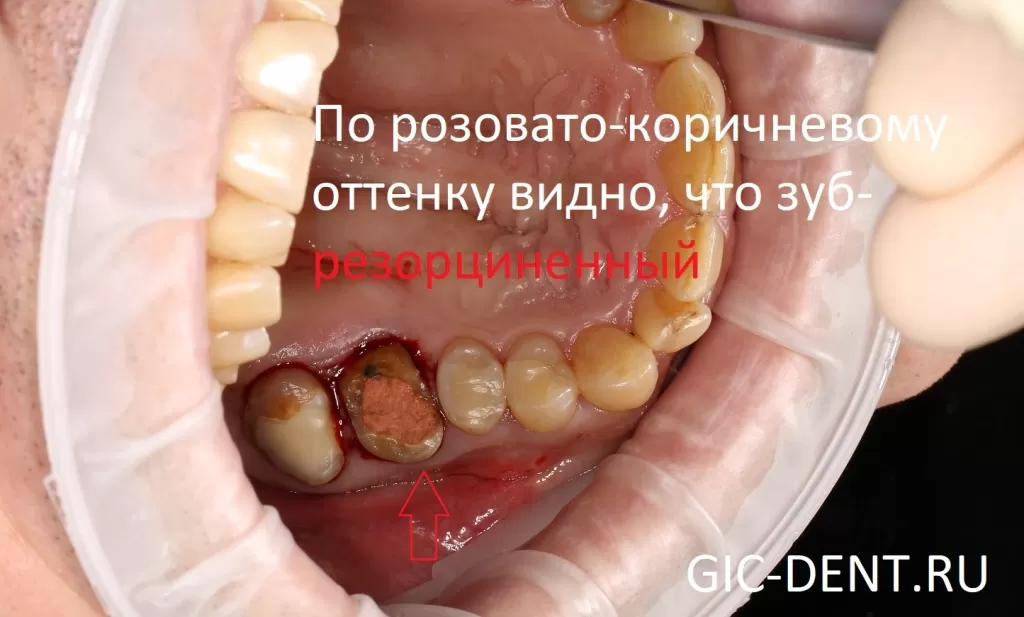Многократное некачественное лечение привело к тому, что зуб уже не подлежал перелечиванию