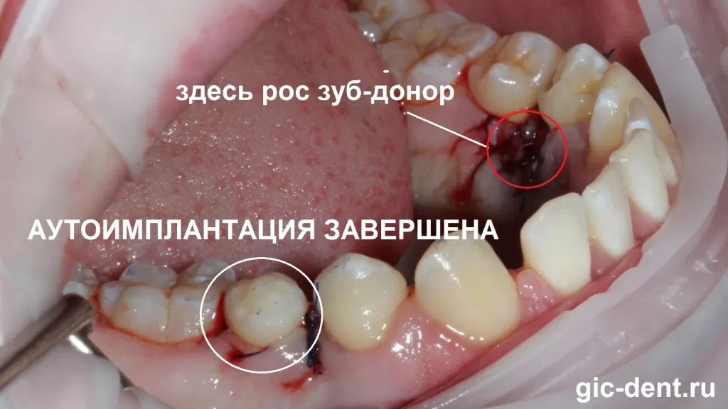 Зуб-донор установлен, и наложены направляющие швы, чтобы не было пустых пространств