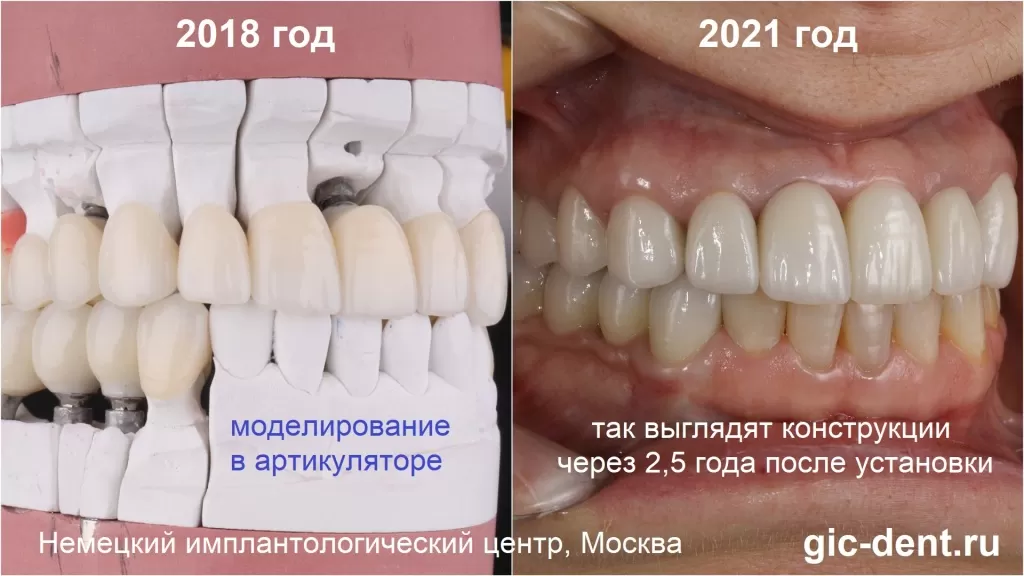На снимке 2021 года – так выглядит наша пациентка через 2,5 года после установки коронок. Немецкий имплантологический центр, Москва