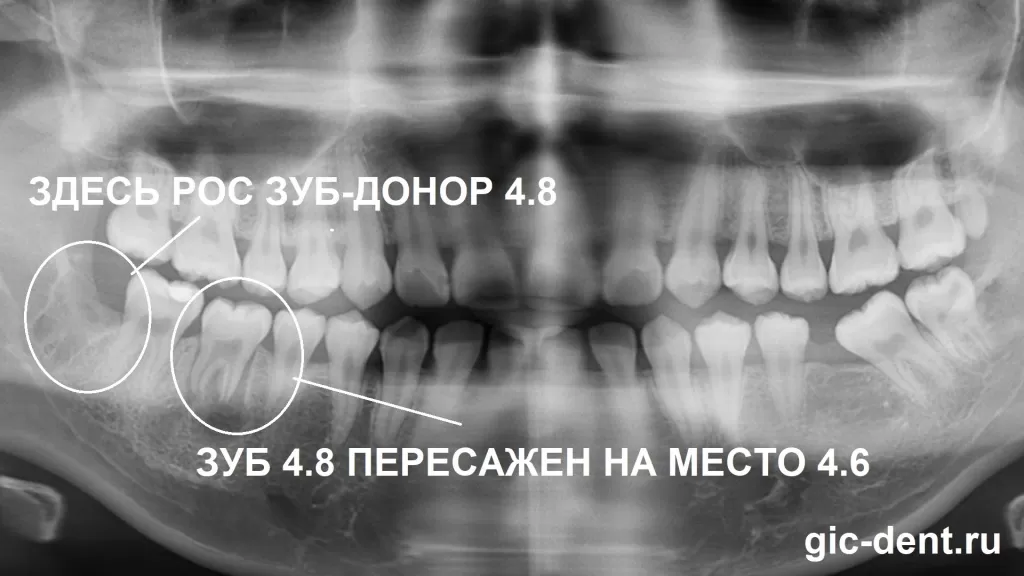 рентген аутотрансплантация зуба мудрости