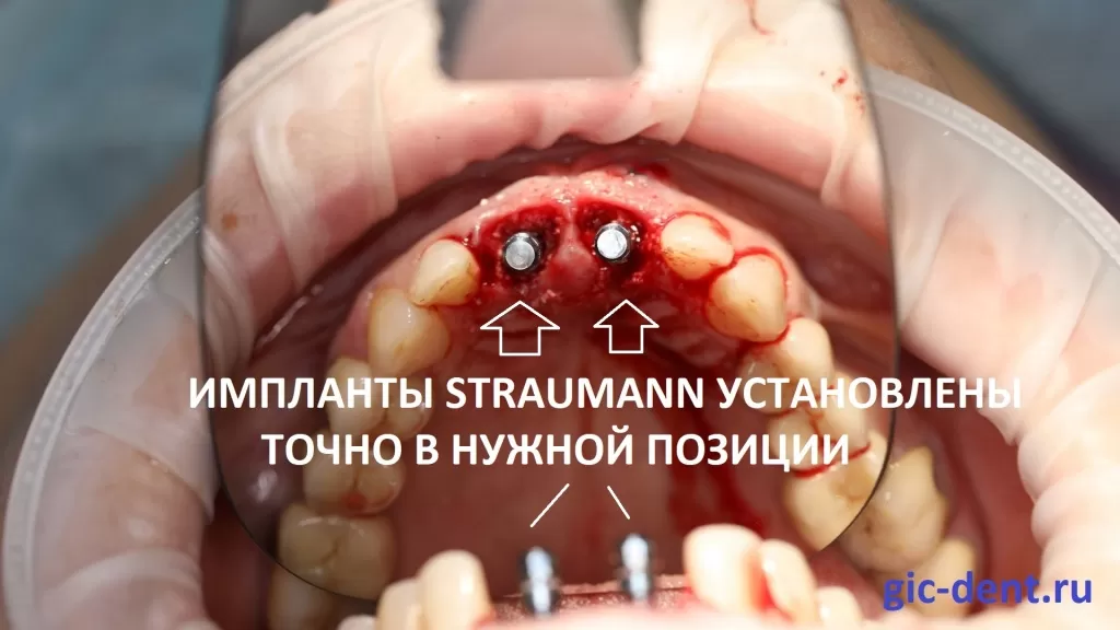 в области зуба, который имел свищевой ход (зуб 11), на фото он справа, было подшита коллагеновая мембрана. Имплантация передних зубов. Хирург Дахкильгов Магомед Уматгиреевич, Немецкий имплантологический Центр