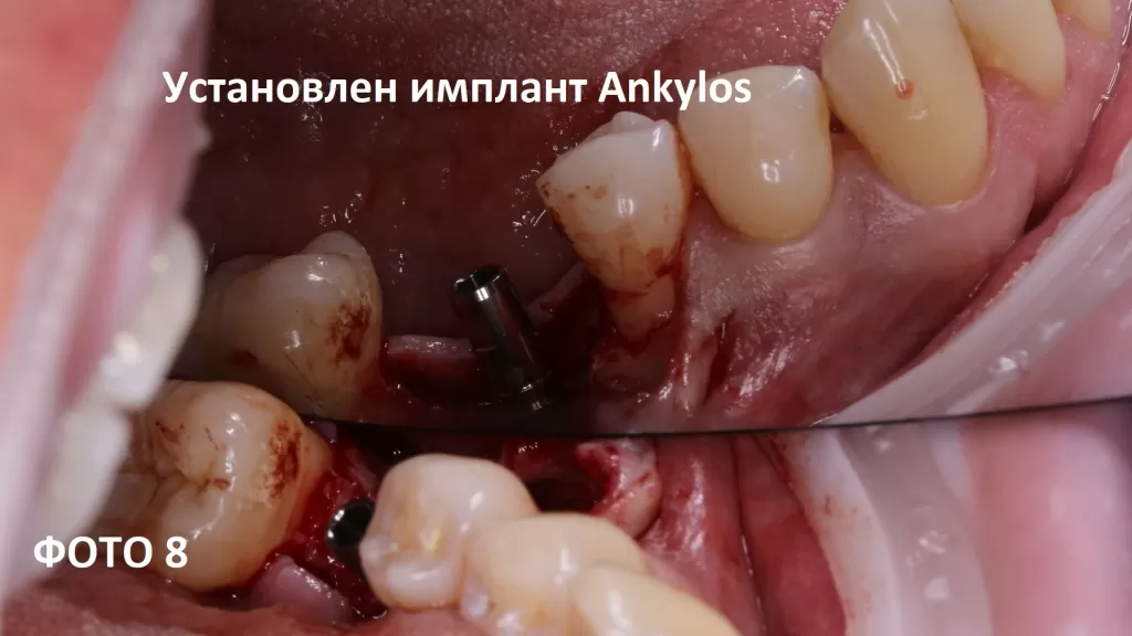 Пациенту был установлен имплант Ankylos