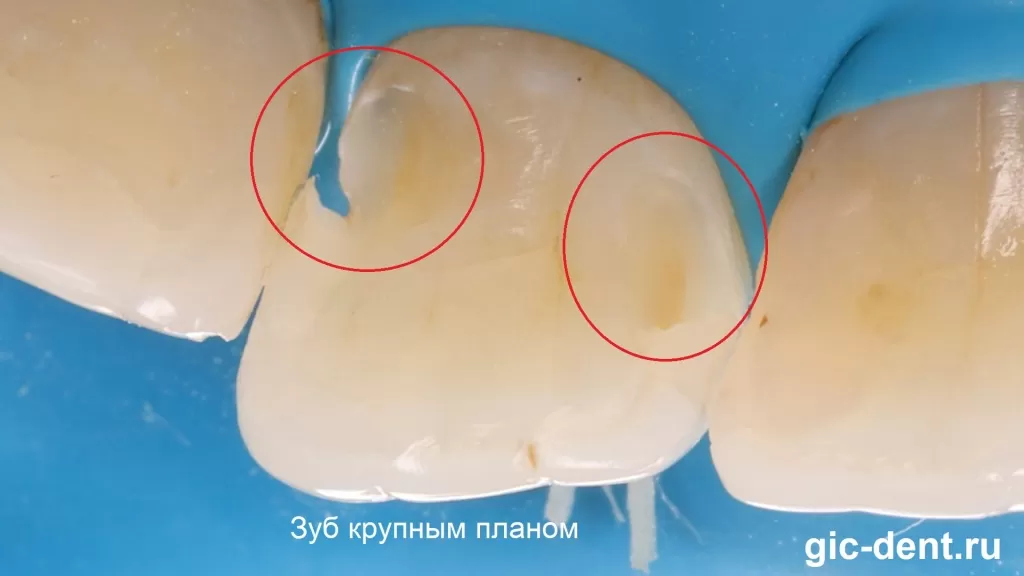 Полости на зубе после очищения их от кариеса