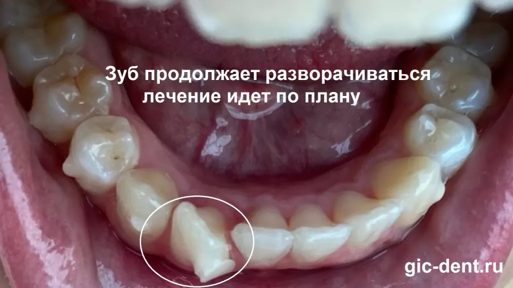 Прошло 5 месяцев - зуб практически в зубном ряду