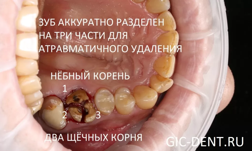 Зуб был аккуратно фрагментирован на три части