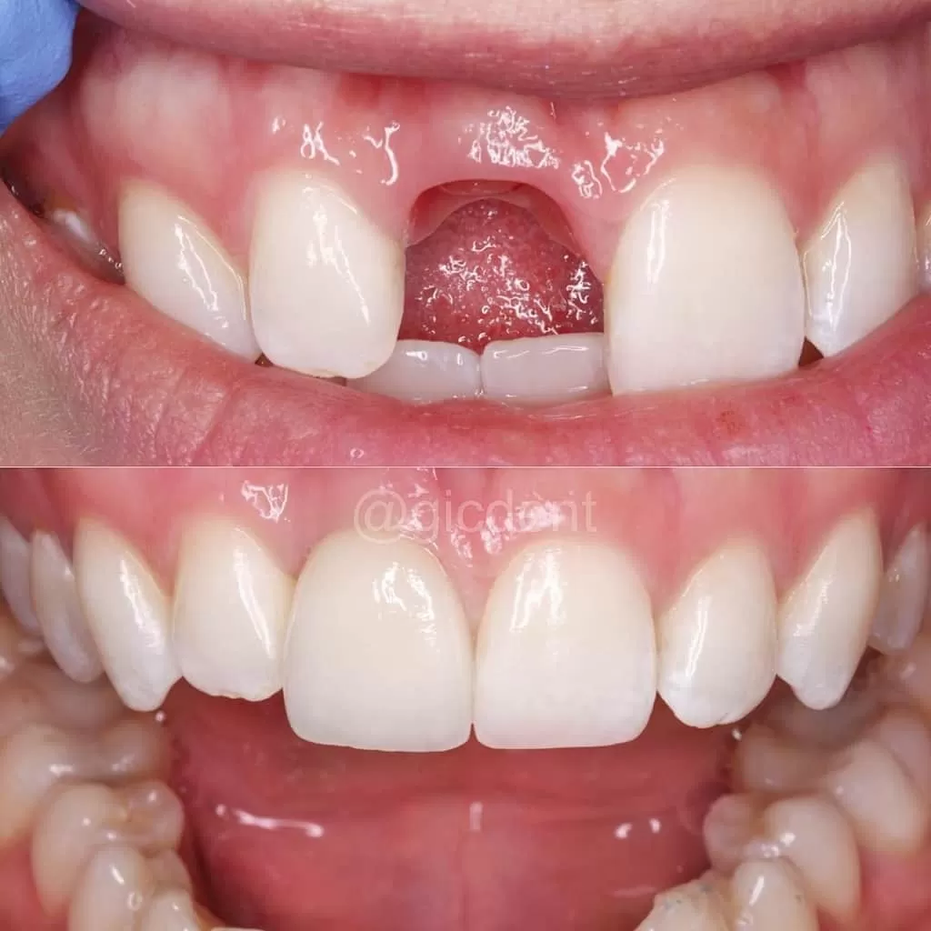 Фото до и после имплантации зубов, работы выполнены в Немецком имплантологическом ценре
