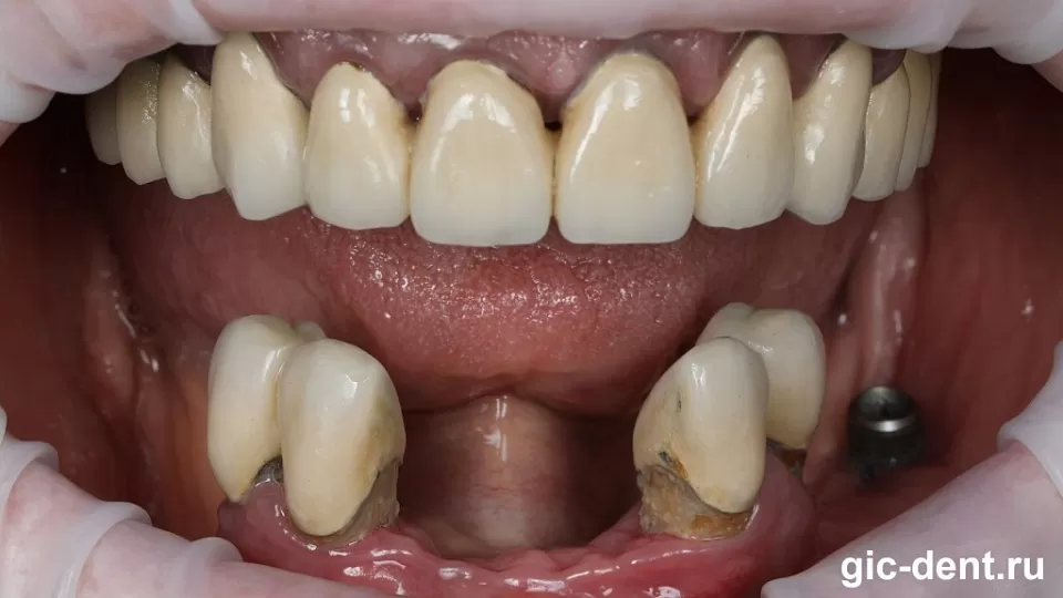 Успешное протезирование нижних зубов all on 4 в 82 года