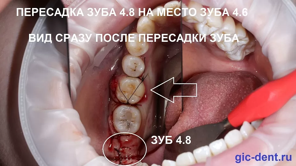 Аутотрансплантация зуба мудрости на место нижней шестерки 4.6