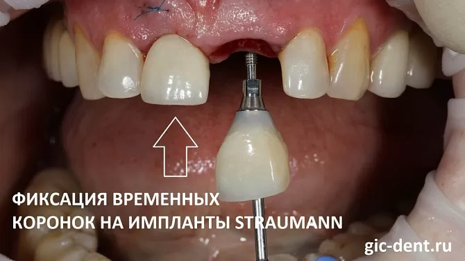 Нужен ли имплант зуба, если нет только одной зубной единицы