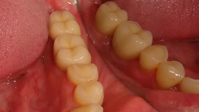 Имплантация и протезирование нижних 6 и 7 зубов