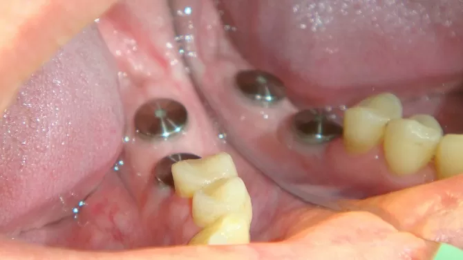 Имплантация и протезирование нижних 6 и 7 зубов