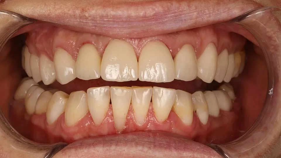 Коронки и виниры на все зубы верхней челюсти с имплантацией 2 жевательных зубо