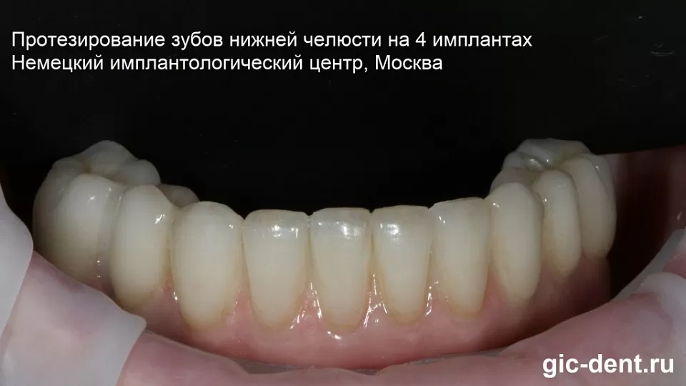 Успешное протезирование нижних зубов all on 4 в 82 года
