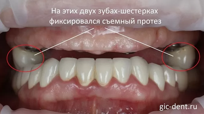 Имплантация верхней челюсти или нижней при полном отсутствии зубов