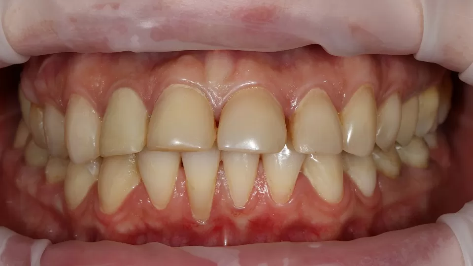 Коронки и виниры на все зубы верхней челюсти с имплантацией 2 жевательных зубо