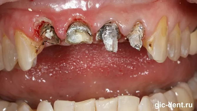 Как восстановить зубы, если они разрушены ниже уровня десны