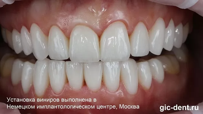 Обточка зубов при установке таких керамических виниров минимальна