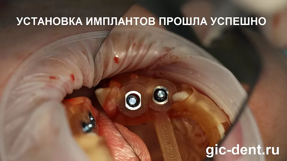 Использование хирургического шаблона при имплантации 5 и 6 зуба