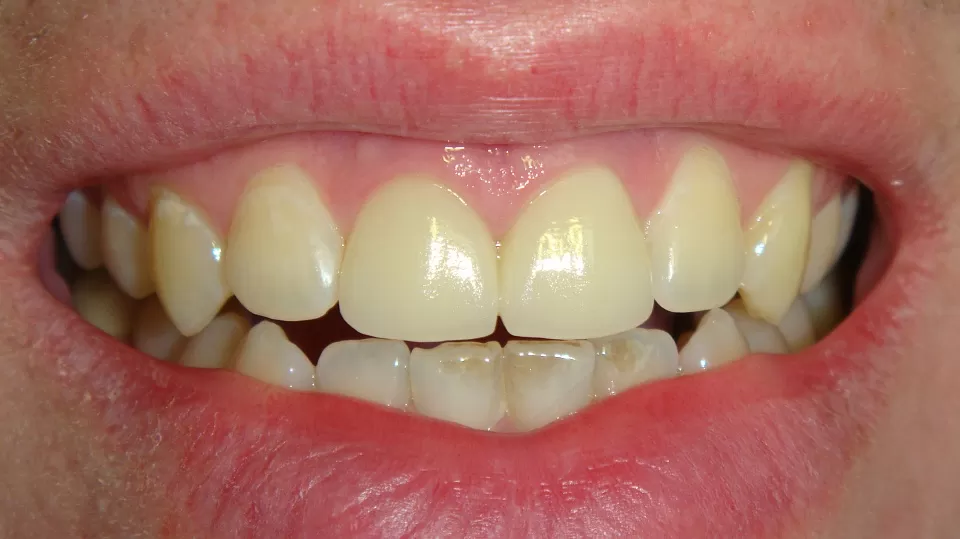 Передние верхние зубы, Протезирование после удара шайбой