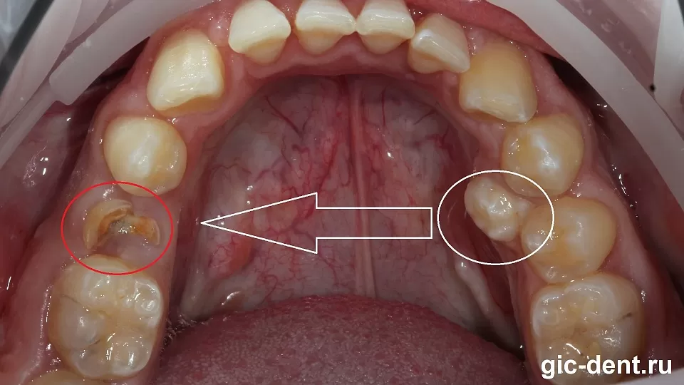 Имплантация собственного зуба (Пересадка зуба) на место 5 нижнего.
