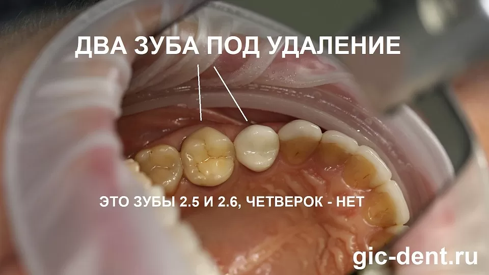 Использование хирургического шаблона при имплантации 5 и 6 зуба