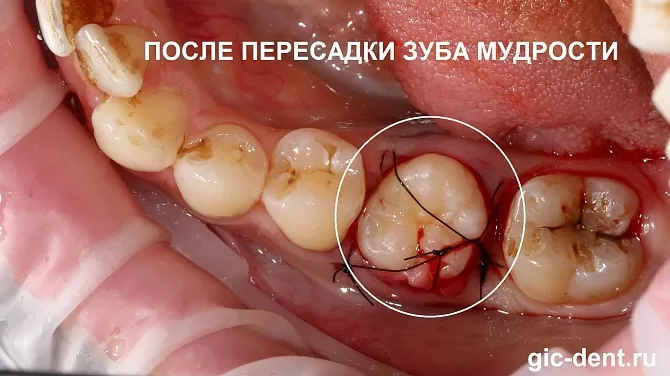 Пересадка верхнего зуба мудрости на место нижнего шестого зуба в ТОП1 клинике Москвы – Немецкий имплантологический центр