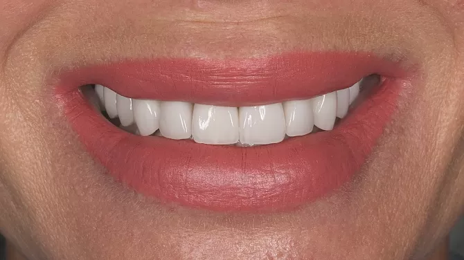 Тотальное протезирование с имплантацией 6 и 7 жевательных зубов