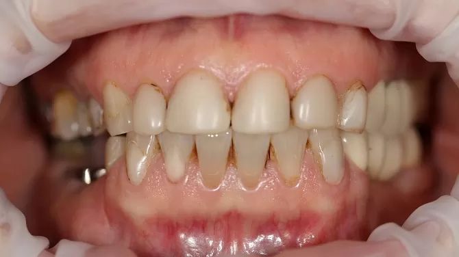 Удаление переднего зуба и импланта с одномоментной имплантацией передних зубов