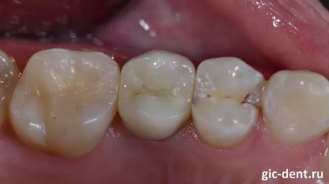Имплантация верхнего зуба 1.5 с формированием эстетики десны и цвета эмали
