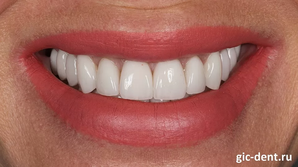 Мощная красота и восстановленная эстетика зубов у нашей пациентки, не находите?