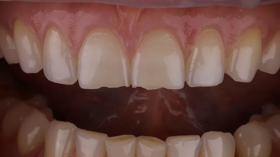 Два передних верхних зуба имели многочисленные сколы по режущему краю.