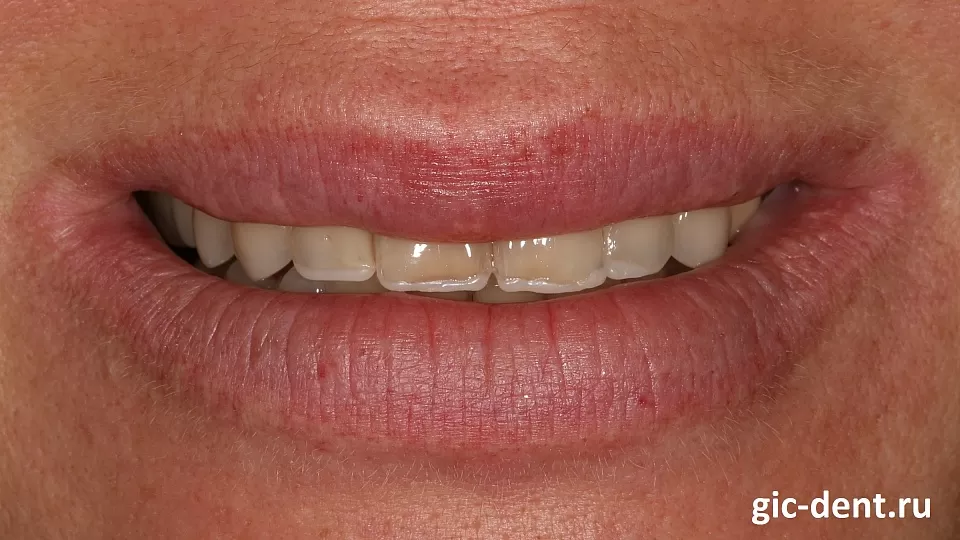 Пациентка обратилась в нашу клинику с целью улучшить эстетический вид своих зубов. Ее не устраивали ни цвет зубов, ни их форма