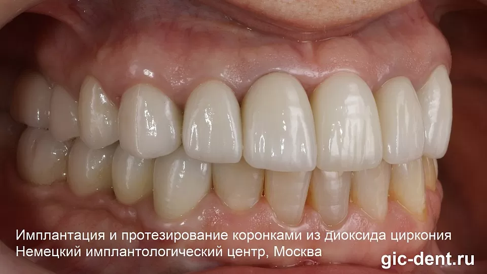 Наши коронки на зубах менять не надо долго – Немецкий имплантологический центр, Москва