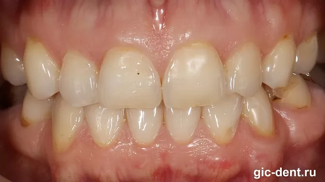 Как получить самые красивые зубы с помощью коронок и виниров