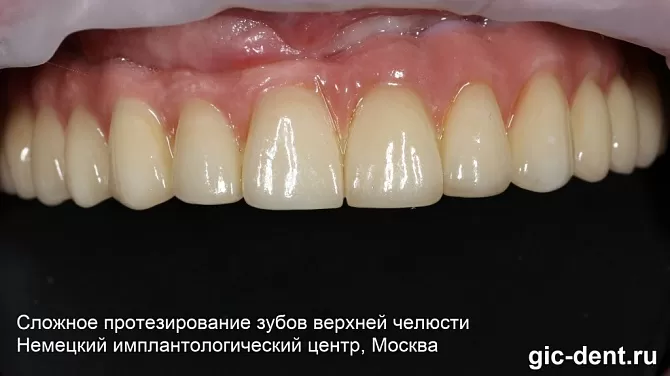 Сложное протезирование зубов верхней челюсти и в 70 лет дает прекрасный результат!