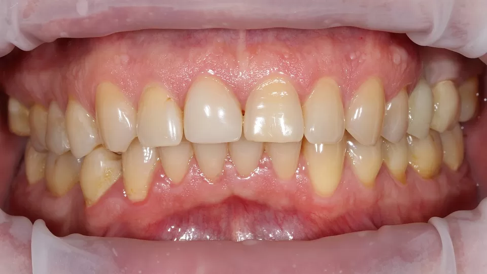 Имплантация с протезированием жевательных зубов. Протезирование передних зубов