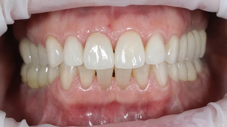 Удаление переднего зуба и импланта с одномоментной имплантацией передних зубов