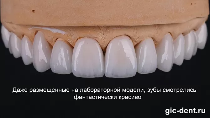 Виниры для зубов: какие лучше, где установить