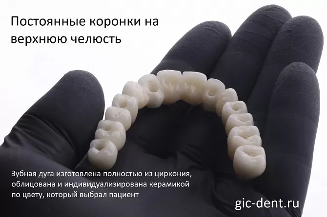 Зачем нужны мостовидные протезы зубов и когда они применяются 